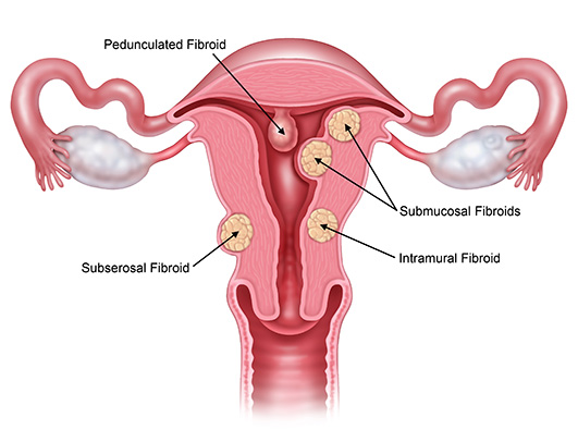 Uterine Fibroids