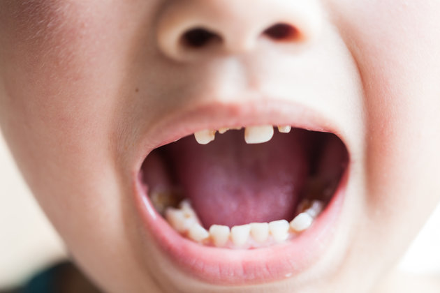 How To Prevent Dental Cavities In Children?