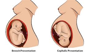 Cephalic Vs Breech