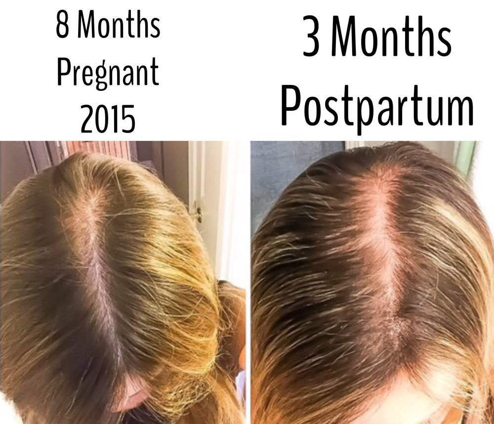 How to prevent hair loss after delivery Postpartum hair loss tips